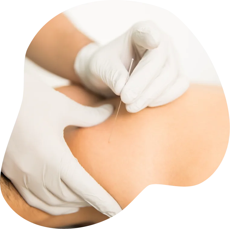 Recurso 6 ACUPUNTURA FISIOTERAPICA
