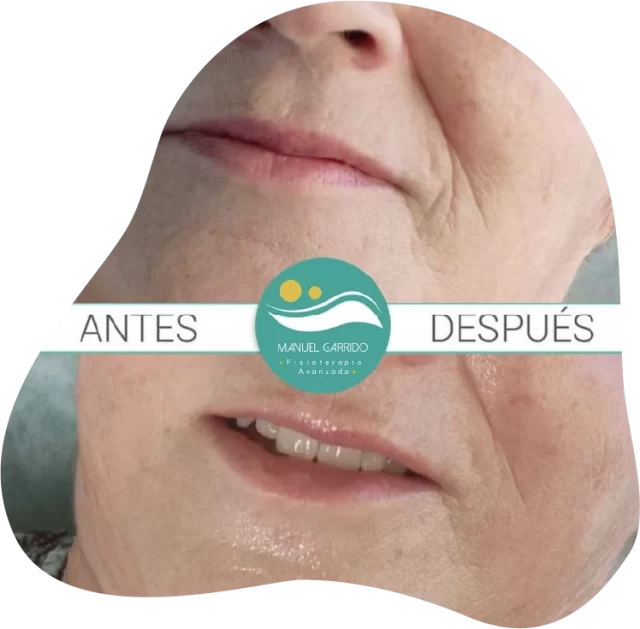 FISIOTERAPIA DERMATOFUNCIONAL